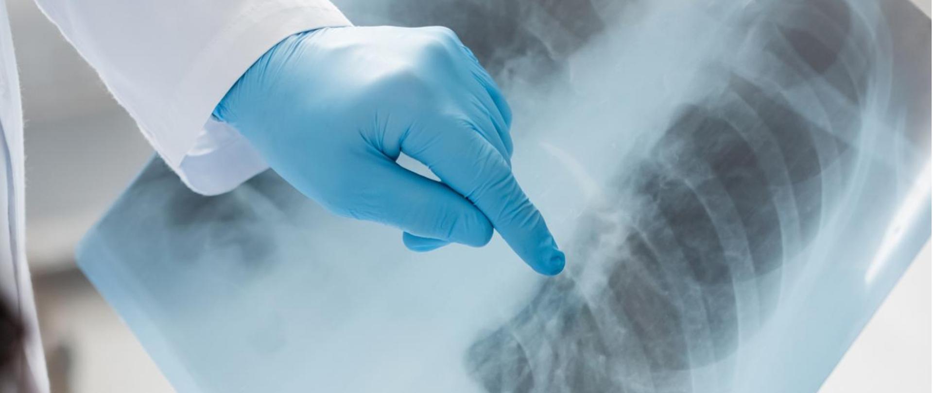Na zdjęciu lekarz trzyma zdjęcie rentgenowskie płuc.